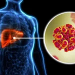 Cegah Penularan Hepatitis